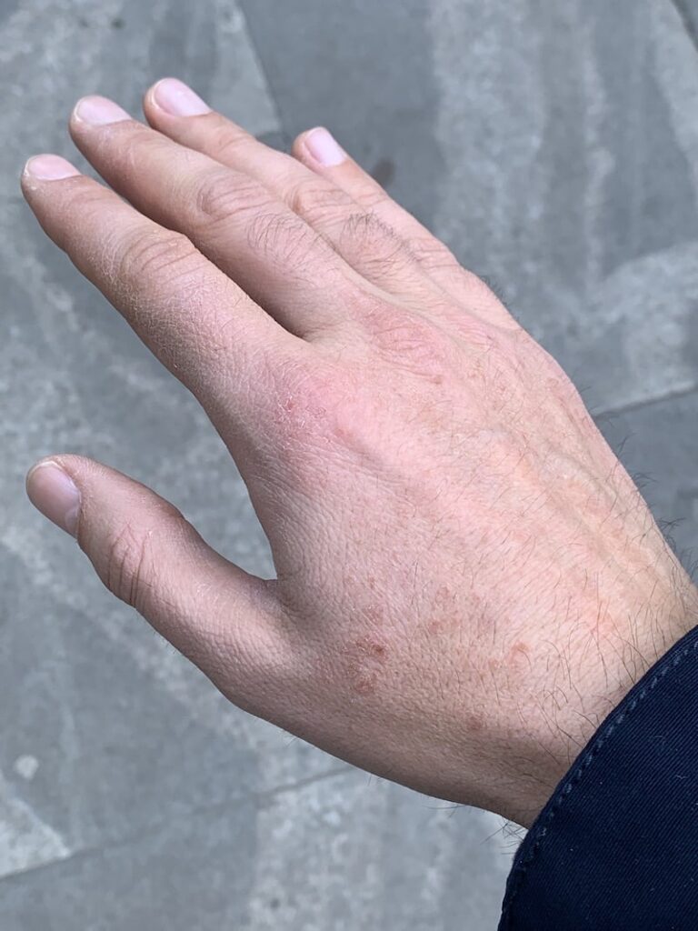 krema za atopijski dermatitis